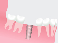 インプラント治療の流れ