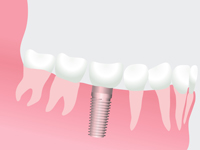 インプラント治療の流れ